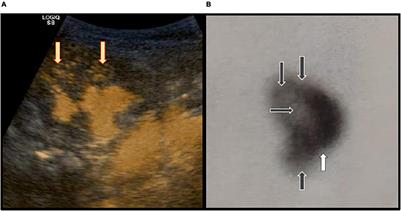 The Spectrum of Parenchymal Changes in Kidneys Affected by Intrarenal Reflux, Diagnosed by Contrast-Enhanced Voiding Urosonography and DMSA Scan